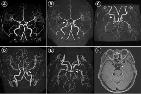 the villages mri head|Magnetic Resonance Angiography .